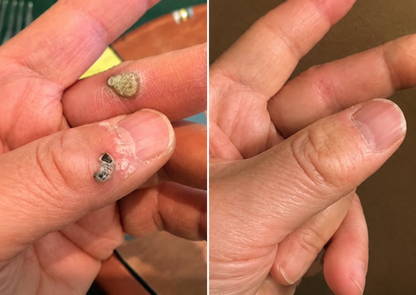 NATRAVOR® 2-in-1 Microneedle & Hydrocolloid Patch🍀| Removes Raised Moles, Acne, Flat Warts & Skin Tags | Helps Improve Wrinkles, Scars & Blemishes | Invisible Patches for Face & Body