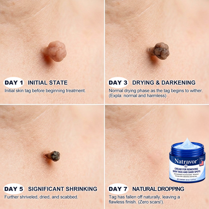 Natravor® 7-𝐃𝐚𝐲 𝐒𝐤𝐢𝐧 𝐓𝐚𝐠 & 𝐒𝐩𝐨𝐭 𝐄𝐫𝐚𝐬𝐞𝐫 𝐂𝐫𝐞𝐚𝐦 (Zero Pain, Zero 𝐒𝐜𝐚𝐫𝐬 Formula) 🎈