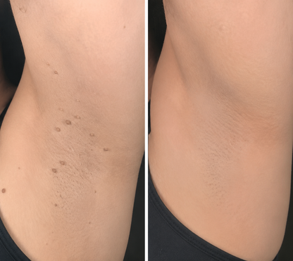 NATRAVOR® 2-in-1 Microneedle & Hydrocolloid Patch🍀| Removes Raised Moles, Acne, Flat Warts & Skin Tags | Helps Improve Wrinkles, Scars & Blemishes | Invisible Patches for Face & Body