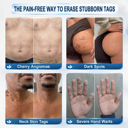 Natravor® 7-𝐃𝐚𝐲 𝐒𝐤𝐢𝐧 𝐓𝐚𝐠 & 𝐒𝐩𝐨𝐭 𝐄𝐫𝐚𝐬𝐞𝐫 𝐂𝐫𝐞𝐚𝐦 (Zero Pain, Zero 𝐒𝐜𝐚𝐫𝐬 Formula) 🎈